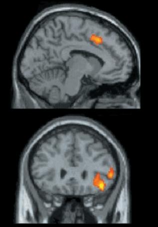Fig. 2. The upper image shows the activation in the area of anterior cingulate cortex, the lower in the right ventral prefrontal cortex. Adapted and edited from Eisenberger (2003)
